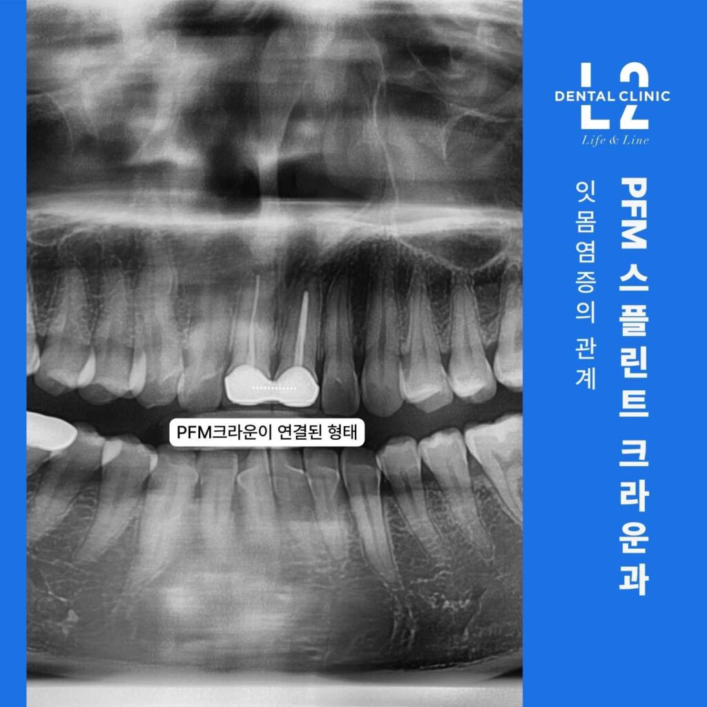 파노라마 엑스레이 사진에 ‘PFM크라운이 연결된 형태’ 표기가 있는 이미지.