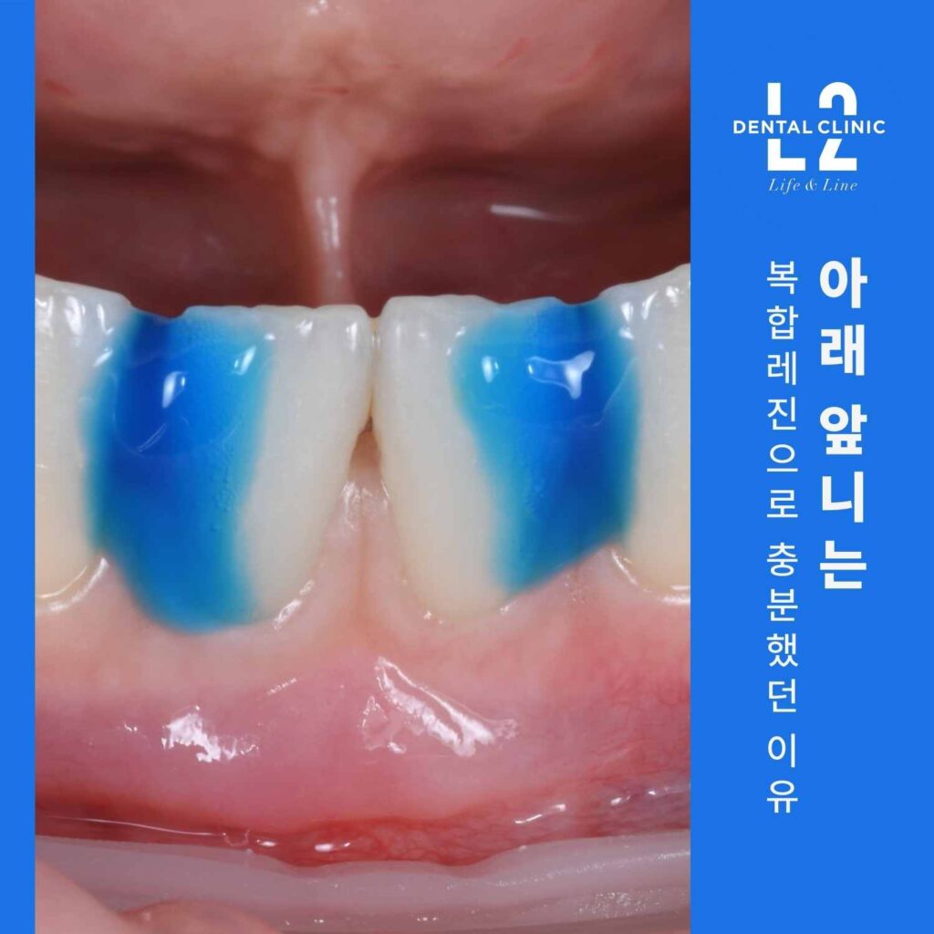아래 앞니 치아사이틈을 복합레진으로 치료한 과정 사진