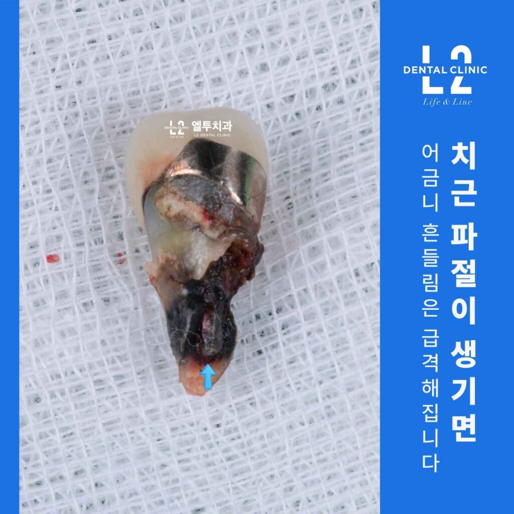 치근 파절로 인해 발치된 어금니 실물 사진