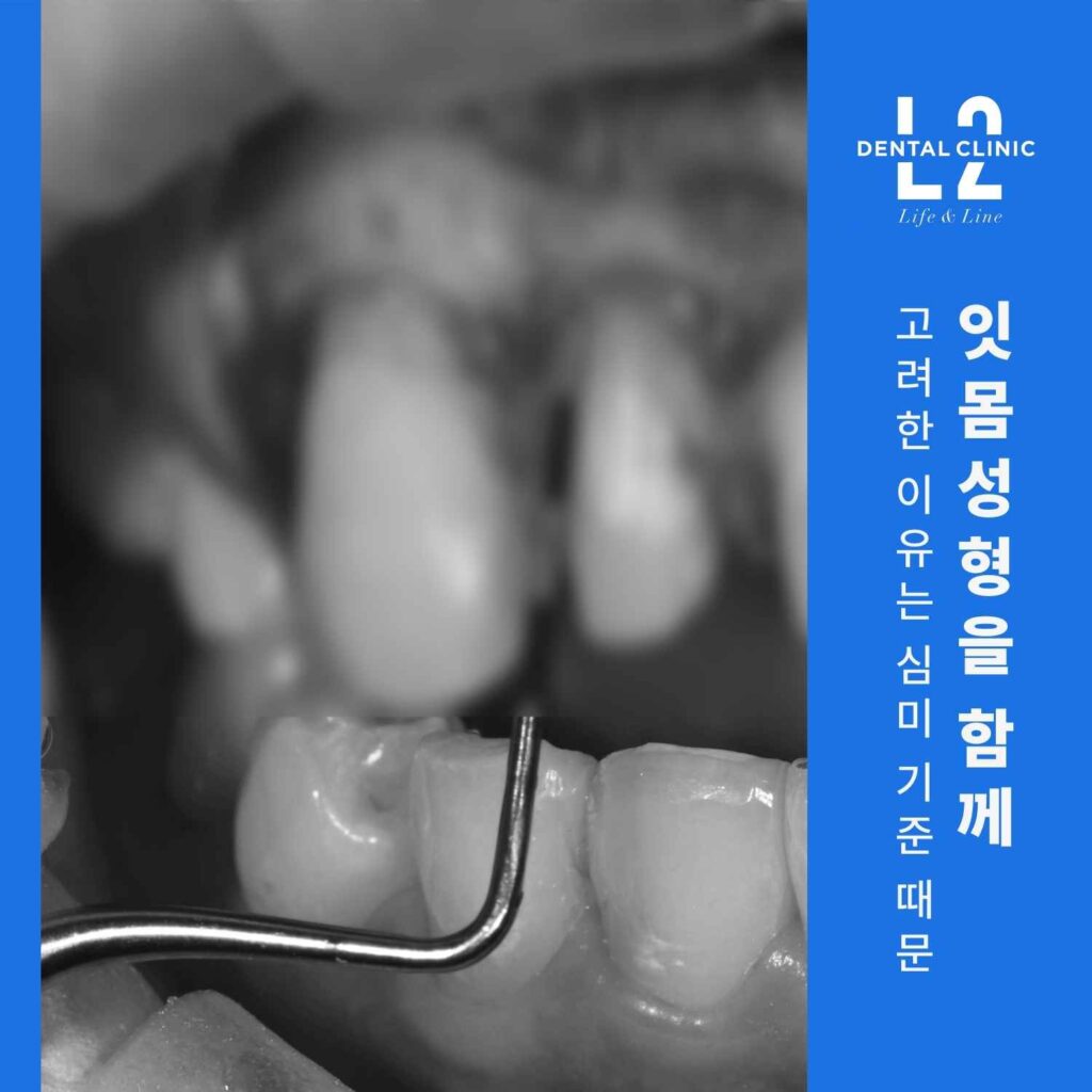 재신경치료 후 심미 기준을 고려한 앞니 전처치 과정 사진