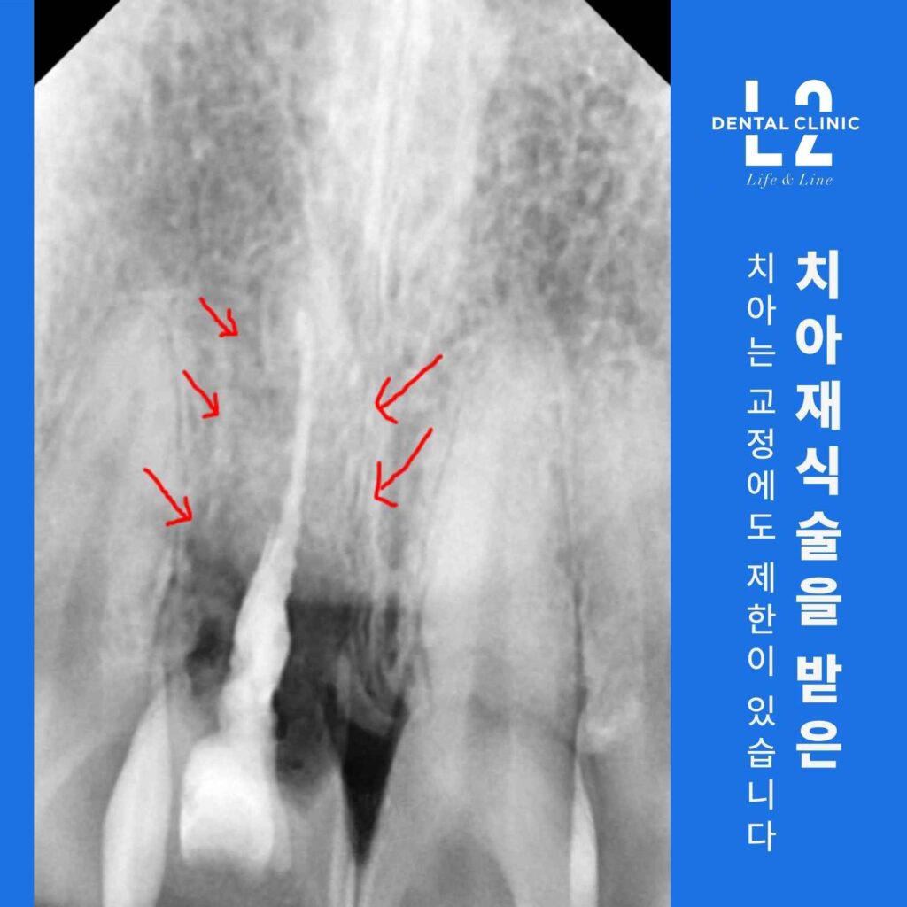치아재식술 후 유착으로 인해 교정 이동이 제한된 치아의 방사선 이미지