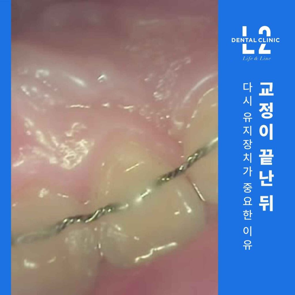 윗니교정 재치료 후 유지장치 재부착 모습