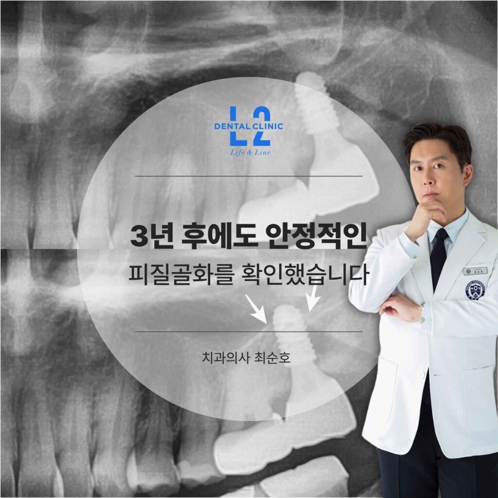 상악동거상술 후 3년 경과에서 피질골화를 확인한 엑스레이 인포그래픽 이미지.