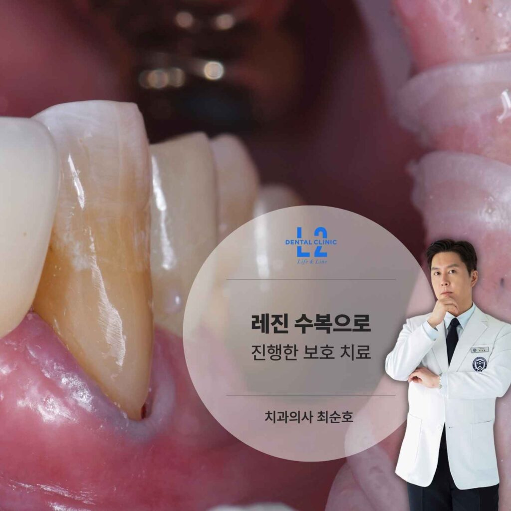 치경부 굴곡 파절 부위를 레진으로 수복한 치료 후 모습