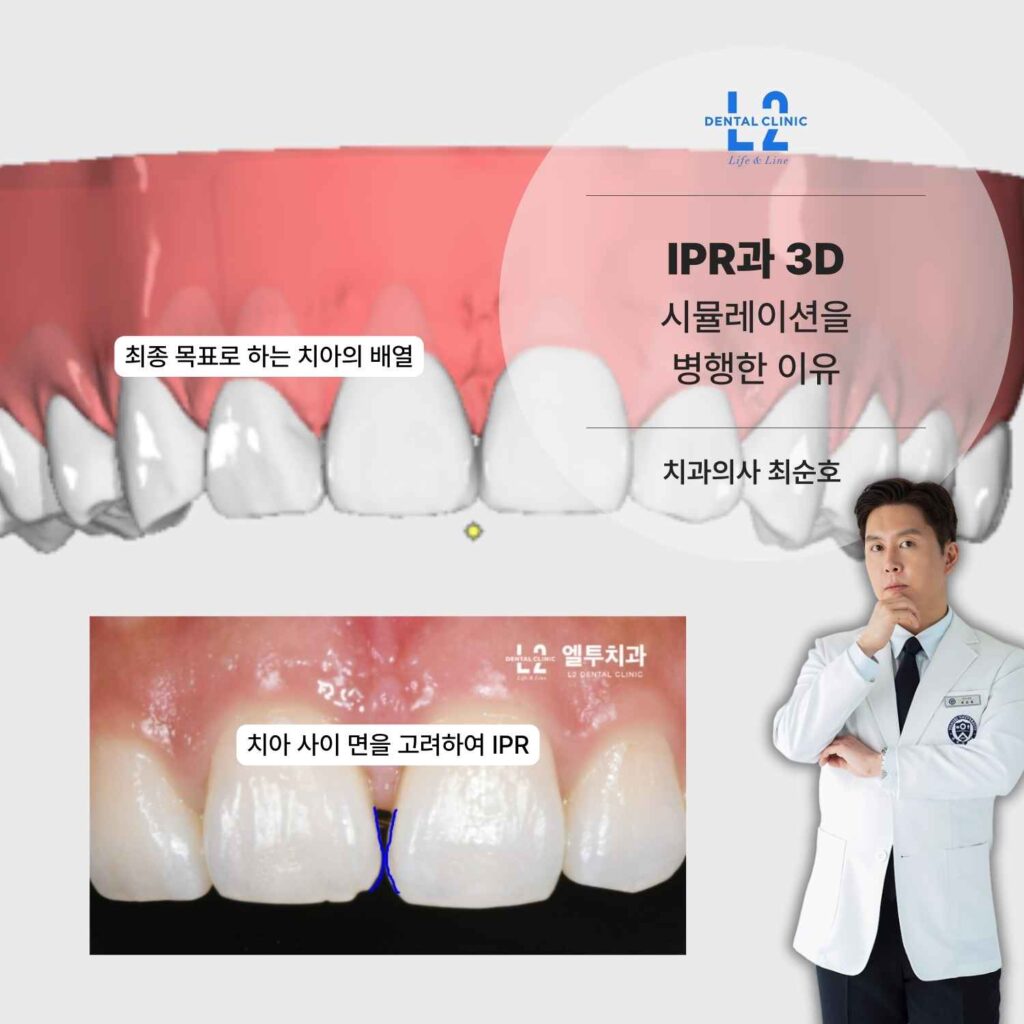 IPR과 3D 시뮬레이션을 병행한 투명교정 치료 계획 이미지