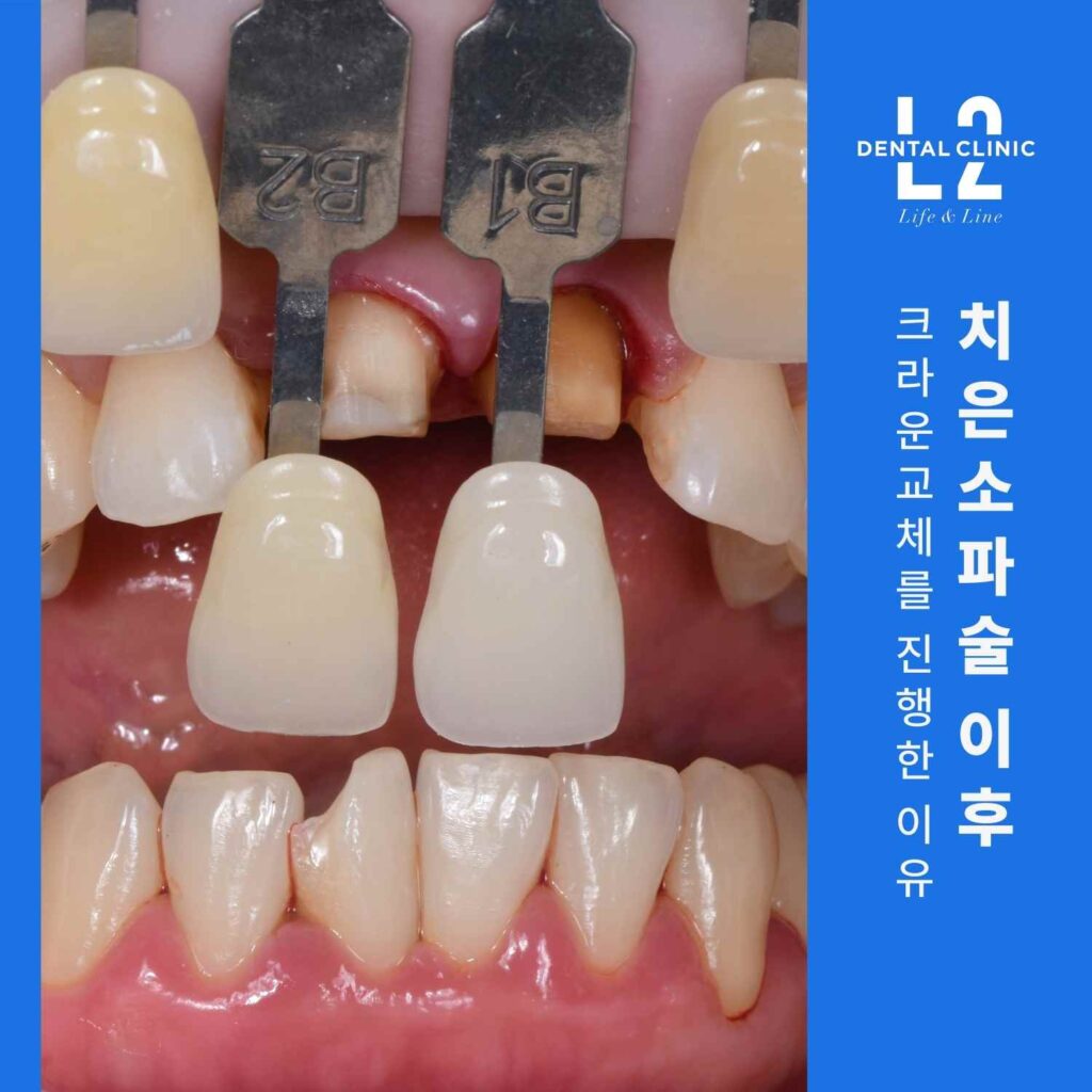 앞니 크라운 제거 단계의 구강 사진과 ‘치은소파술 이후 크라운교체를 진행한 이유’ 문구.
