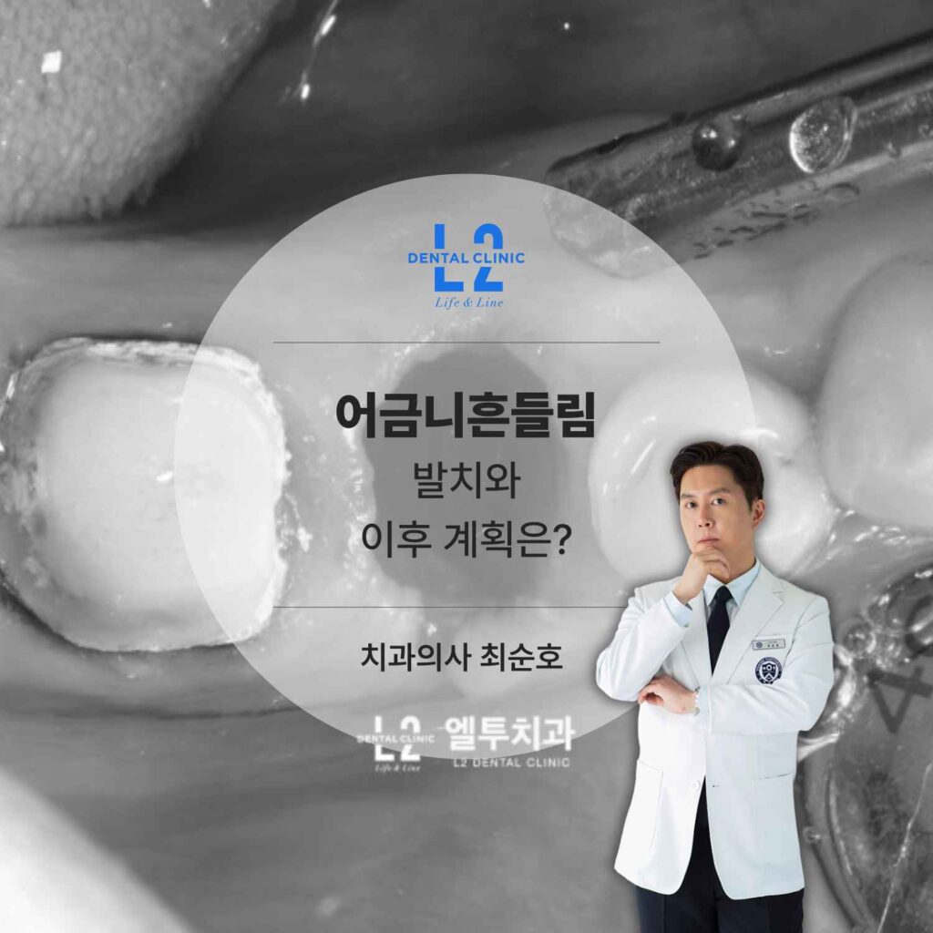어금니 발치 후 임플란트 치료 계획을 설명하는 이미지