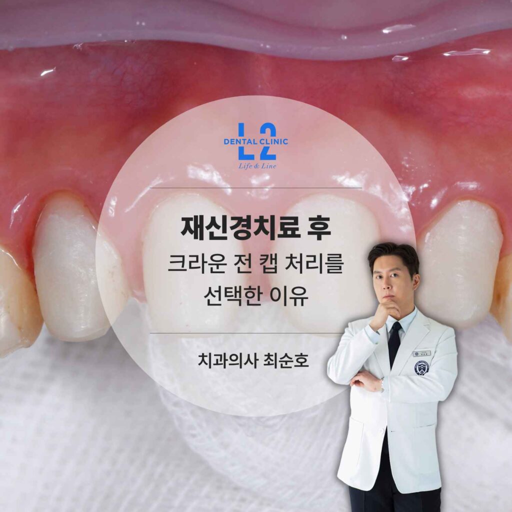 재신경치료 후 재변색 예방을 위한 지대치 캡 처리 사진