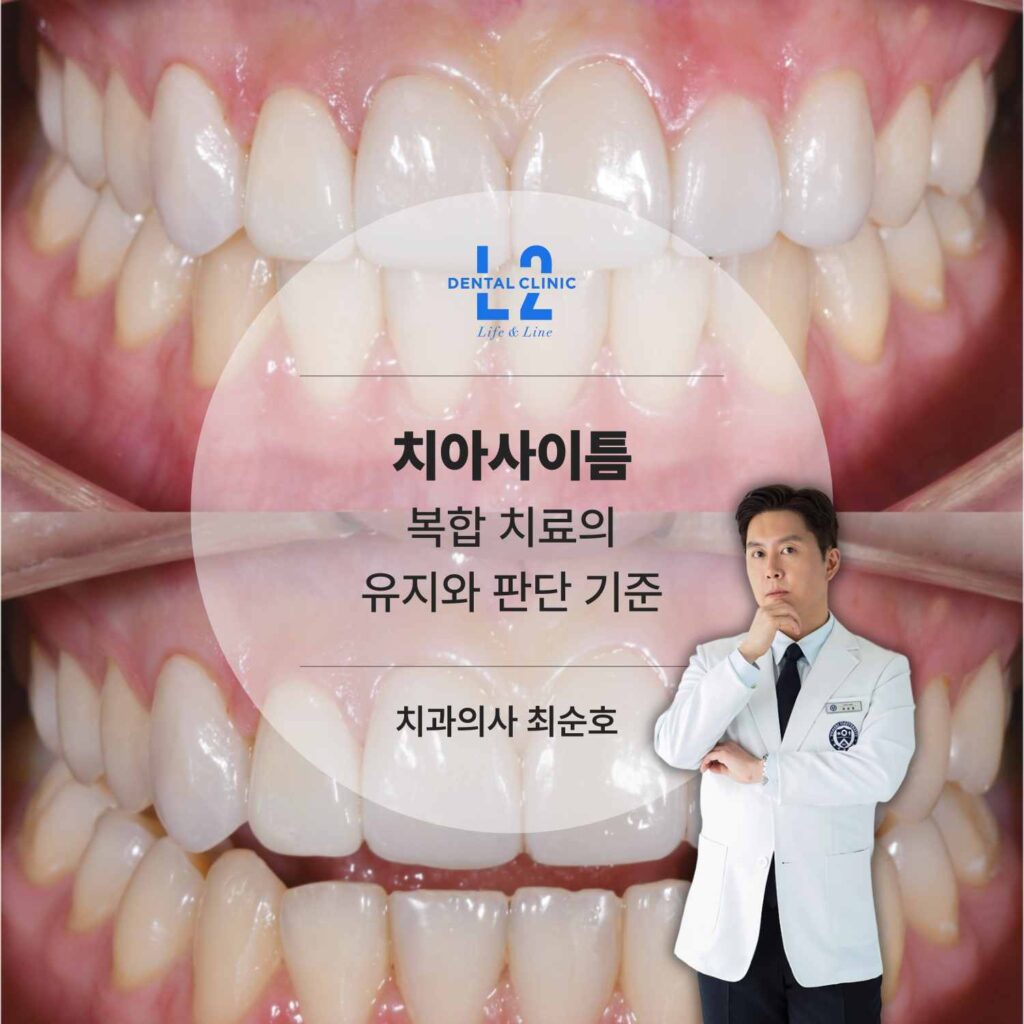 치아사이틈 라미네이트와 레진 복합 치료 후 정면 구강 사진