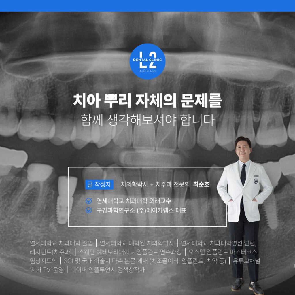 어금니 흔들림 원인으로 치아 뿌리 문제를 강조한 엑스레이 이미지