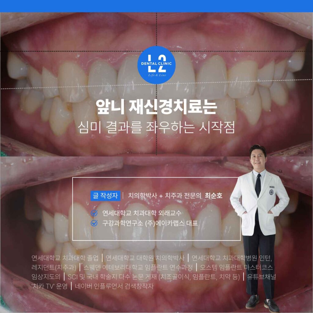 앞니 재신경치료 후 심미적 결과를 정리한 최종 이미지