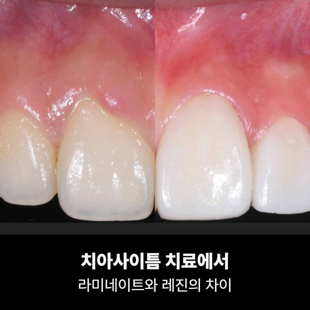 치아사이틈 치료에서 라미네이트와 레진의 차이를 비교한 앞니 정면 사진