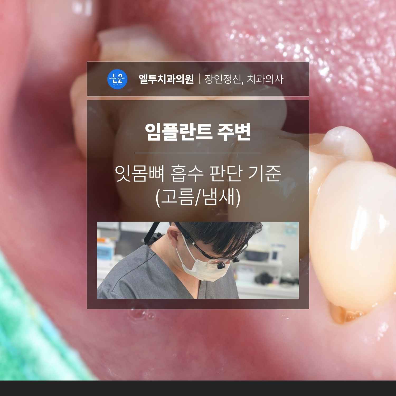 임플란트 주변 잇몸뼈 흡수 판단 기준 임플란트 주변 잇몸뼈 흡수 판단 기준(고름·냄새) 콘텐츠 표지 이미지