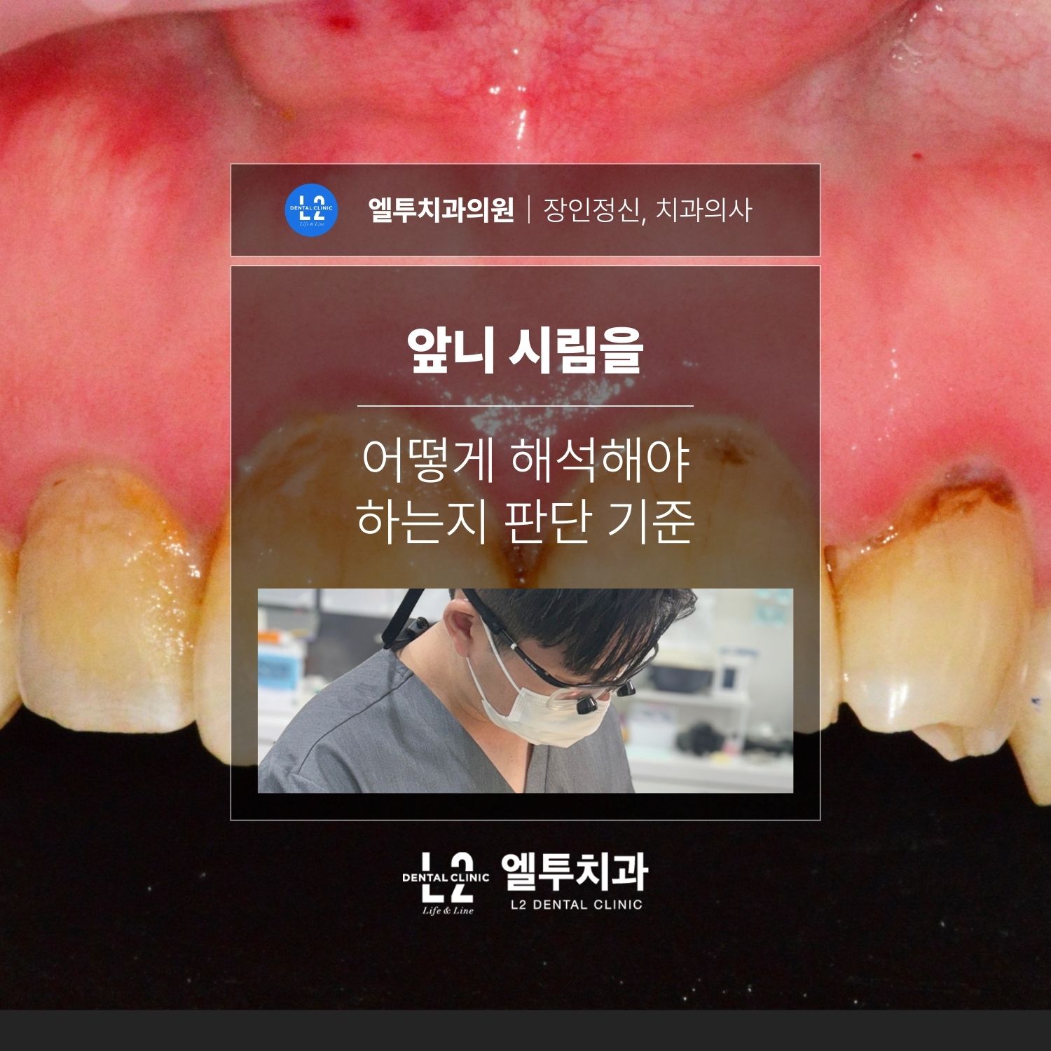 앞니 시림 판단 기준 표지 앞니 사진 위에 ‘앞니 시림을 어떻게 해석해야 하는지 판단 기준’ 제목과 엘투치과 로고가 들어간 표지 이미지