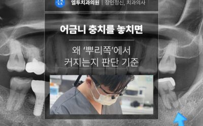 어금니 충치를 놓치면 왜 ‘뿌리쪽’에서 커지는지 판단 기준