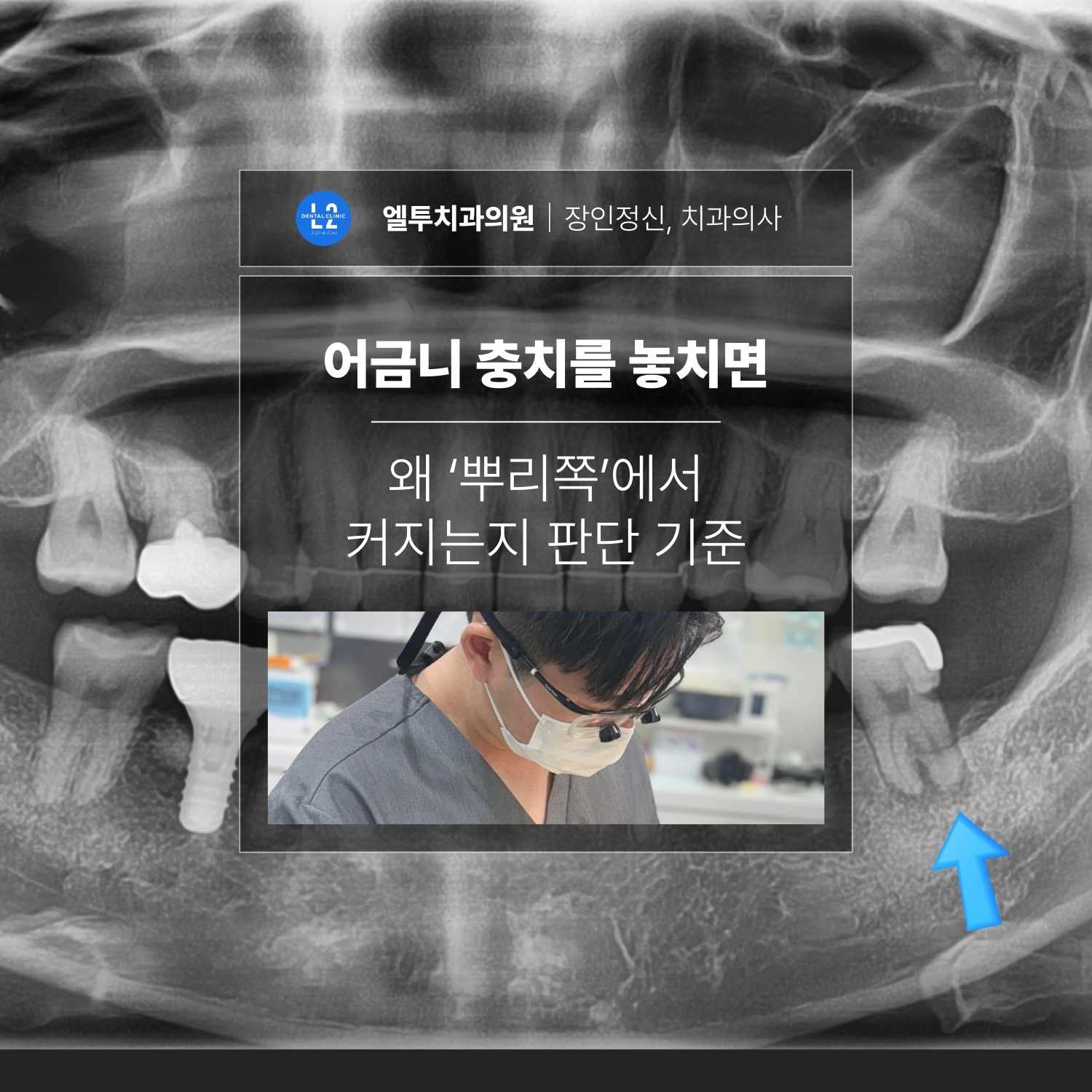 파노라마 엑스레이 배경 위에 ‘어금니 충치를 놓치면 왜 뿌리쪽에서 커지는지 판단 기준’ 문구와 엘투치과 로고가 있는 표지 이미지