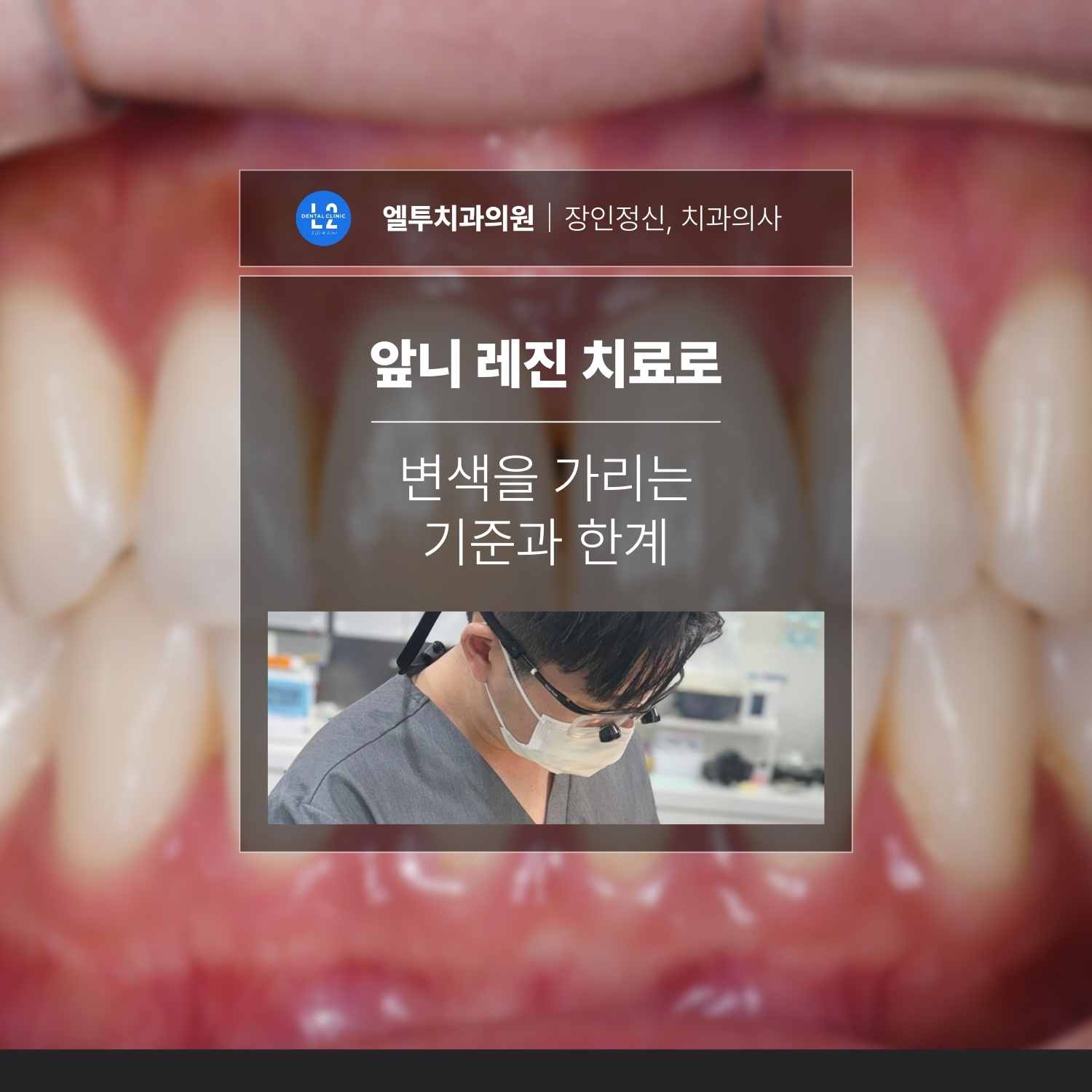 앞니 사진을 배경으로 “앞니 레진 치료로 변색을 가리는 기준과 한계”라는 문구가 중앙에 표시된 카드뉴스 표지. 하단에 진료 중인 원장 사진이 들어가 있다.