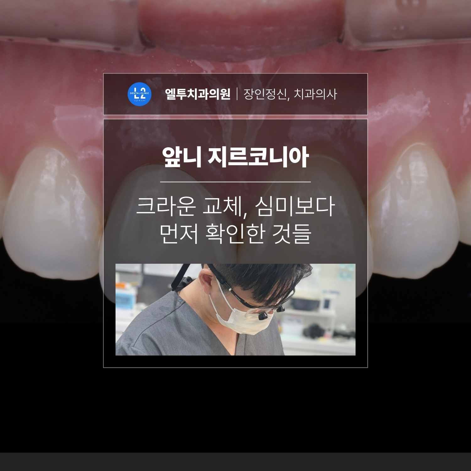 앞니 지르코니아 크라운 교체 사례를 설명하는 치과 치료 대표 이미지