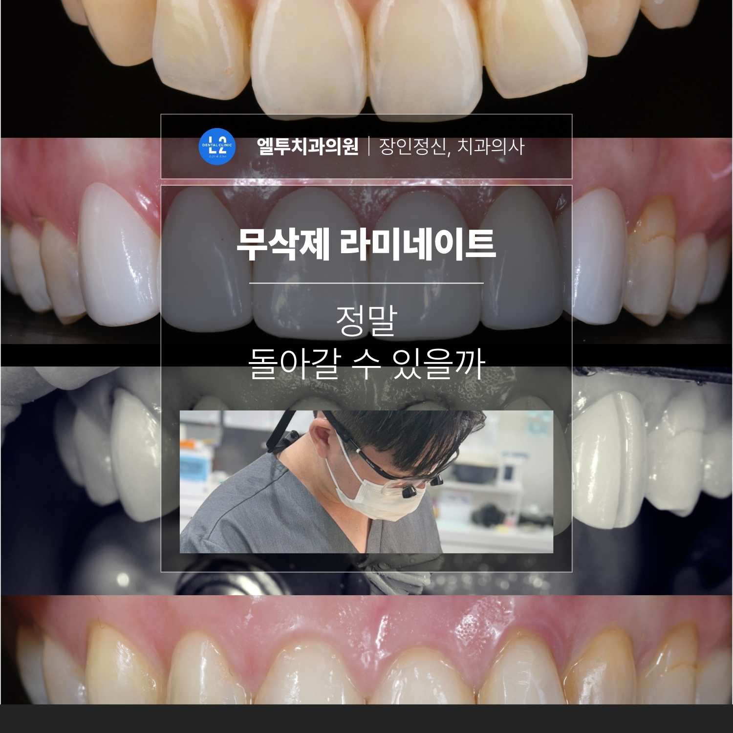 무삭제 라미네이트 치료 후 원래 상태로 돌아갈 수 있는지에 대한 문제를 설명하는 대표 이미지