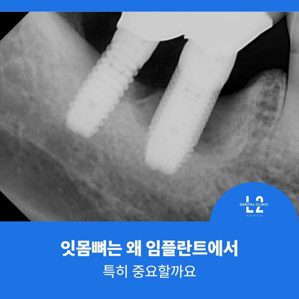 임플란트 주위 잇몸뼈 지지 상태를 보여주는 치근단 엑스레이 이미지