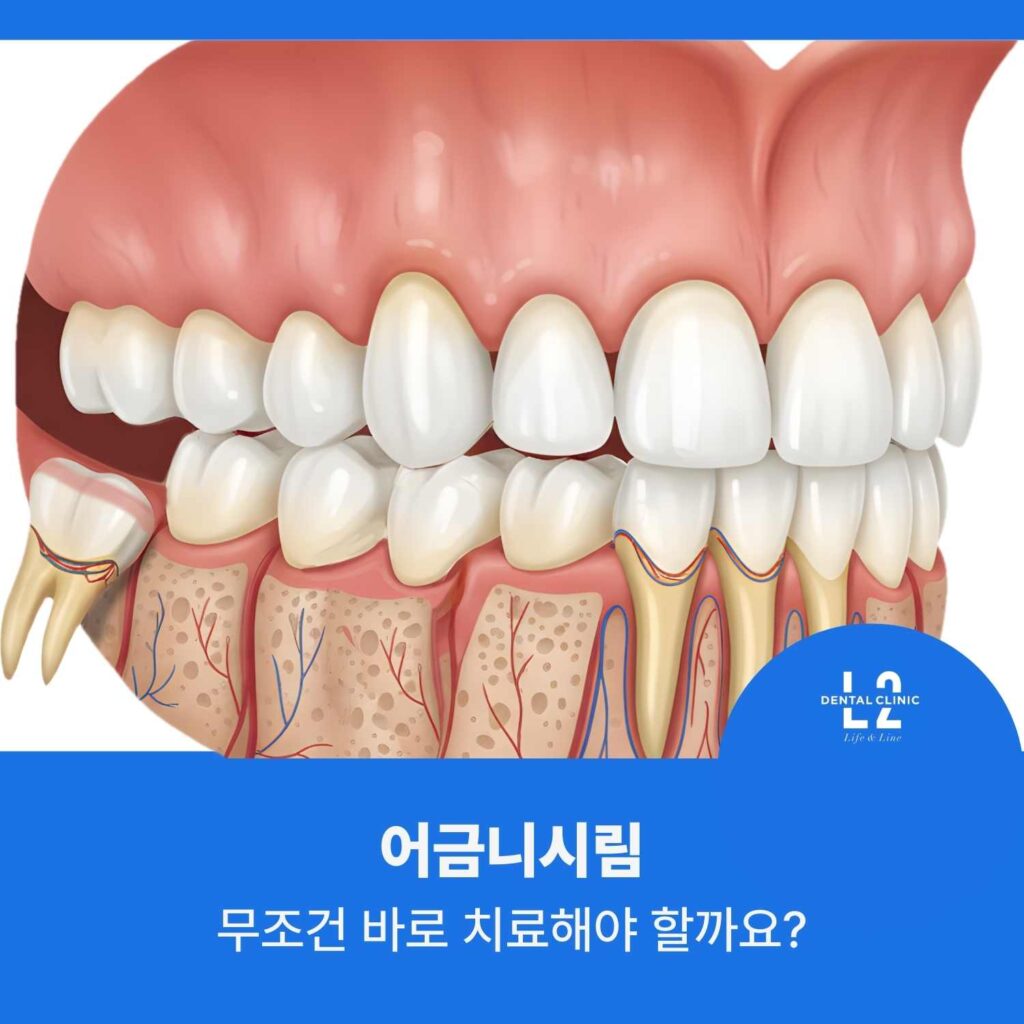 어금니 구조와 신경, 잇몸뼈를 나타낸 치아 단면 일러스트
