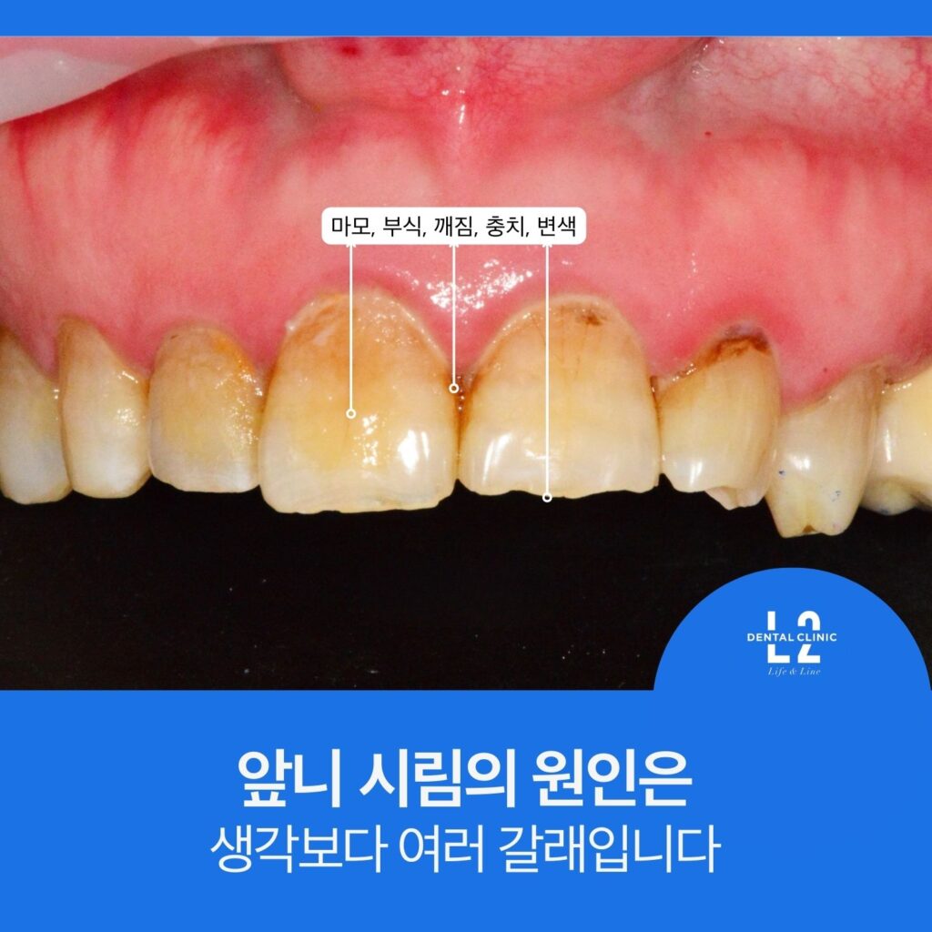 앞니와 잇몸 사진에 ‘마모, 부식, 깨짐, 충치, 변색’ 표시와 ‘앞니 시림의 원인은 생각보다 여러 갈래입니다’ 문구가 있는 카드