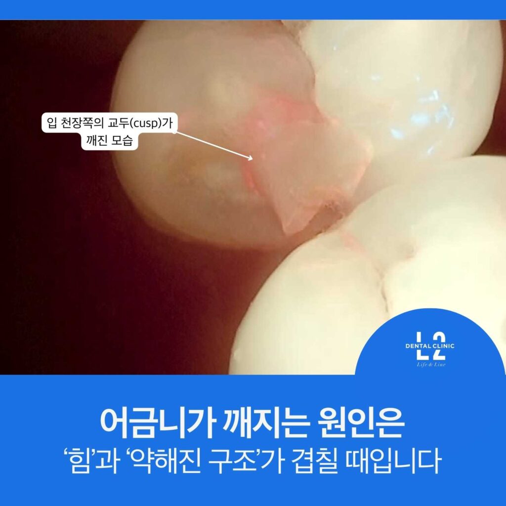 어금니 교두(cusp)가 깨진 부위를 화살표로 표시하고 ‘어금니가 깨지는 원인은 힘과 약해진 구조가 겹칠 때입니다’ 문구가 있는 이미지