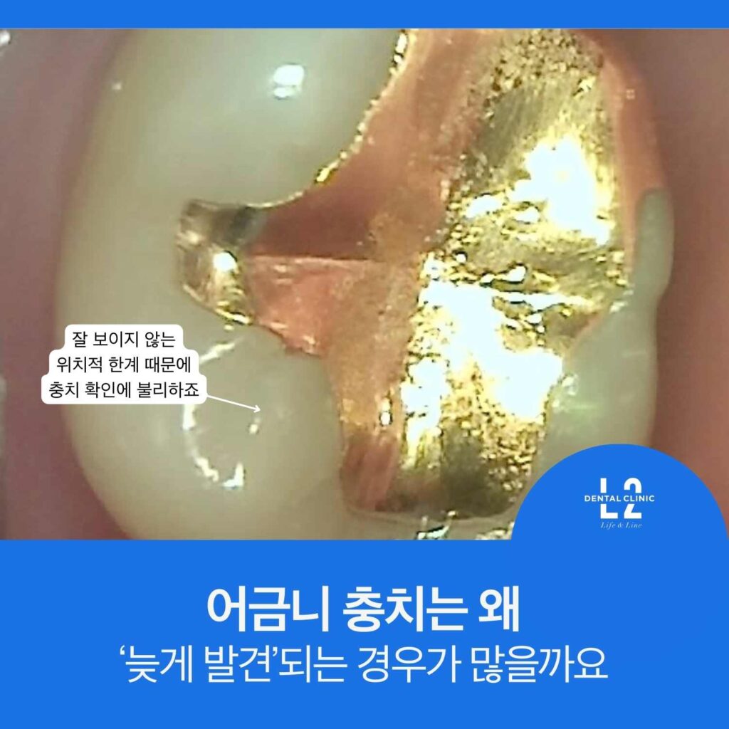 금 인레이가 보이는 어금니 사진에 ‘잘 보이지 않는 위치적 한계 때문에 충치 확인에 불리’ 라벨과 ‘어금니 충치는 왜 늦게 발견되는 경우가 많을까요’ 문구가 있는 카드