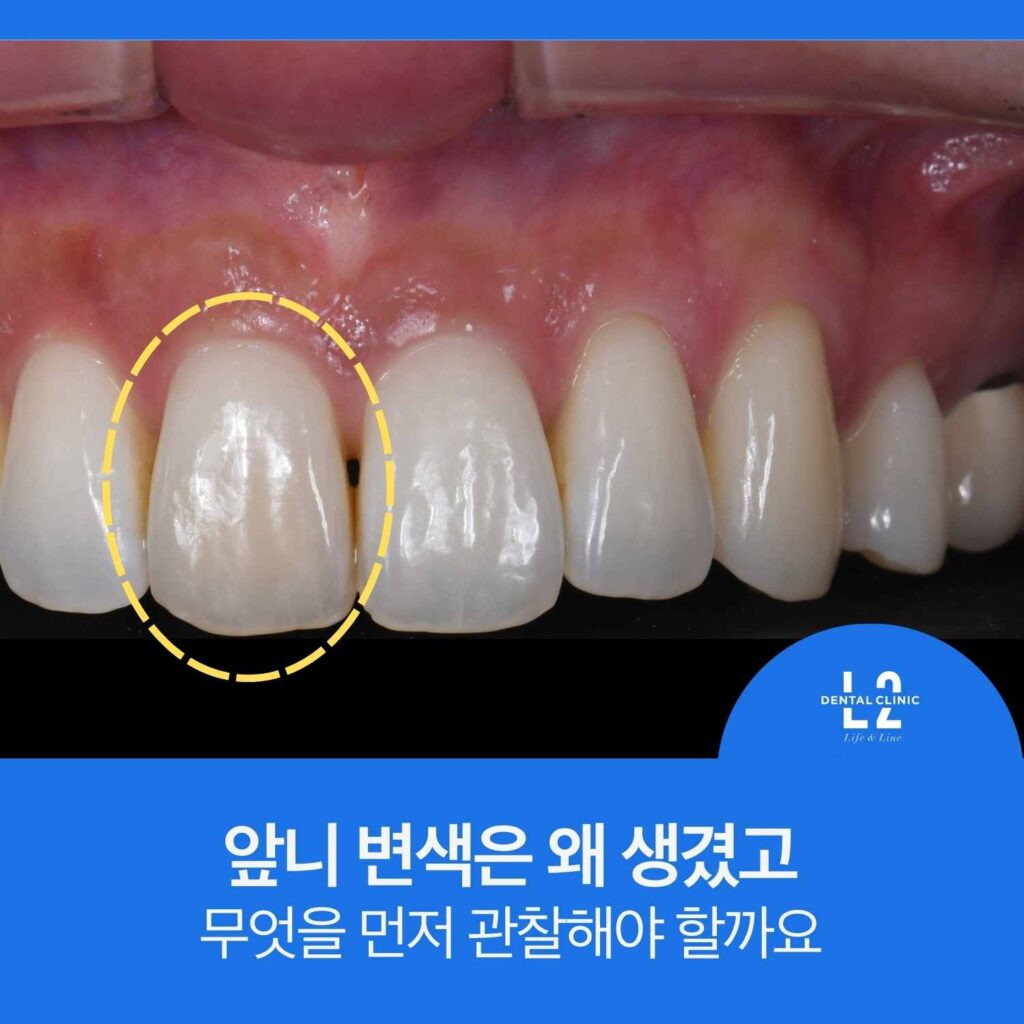 니 여러 개가 보이는 구강 사진에서 한 개의 앞니가 점선 원으로 강조되어 있다. 하단 파란 띠에 “앞니 변색은 왜 생겼고 무엇을 먼저 관찰해야 할까요” 문구와 로고가 있다.
