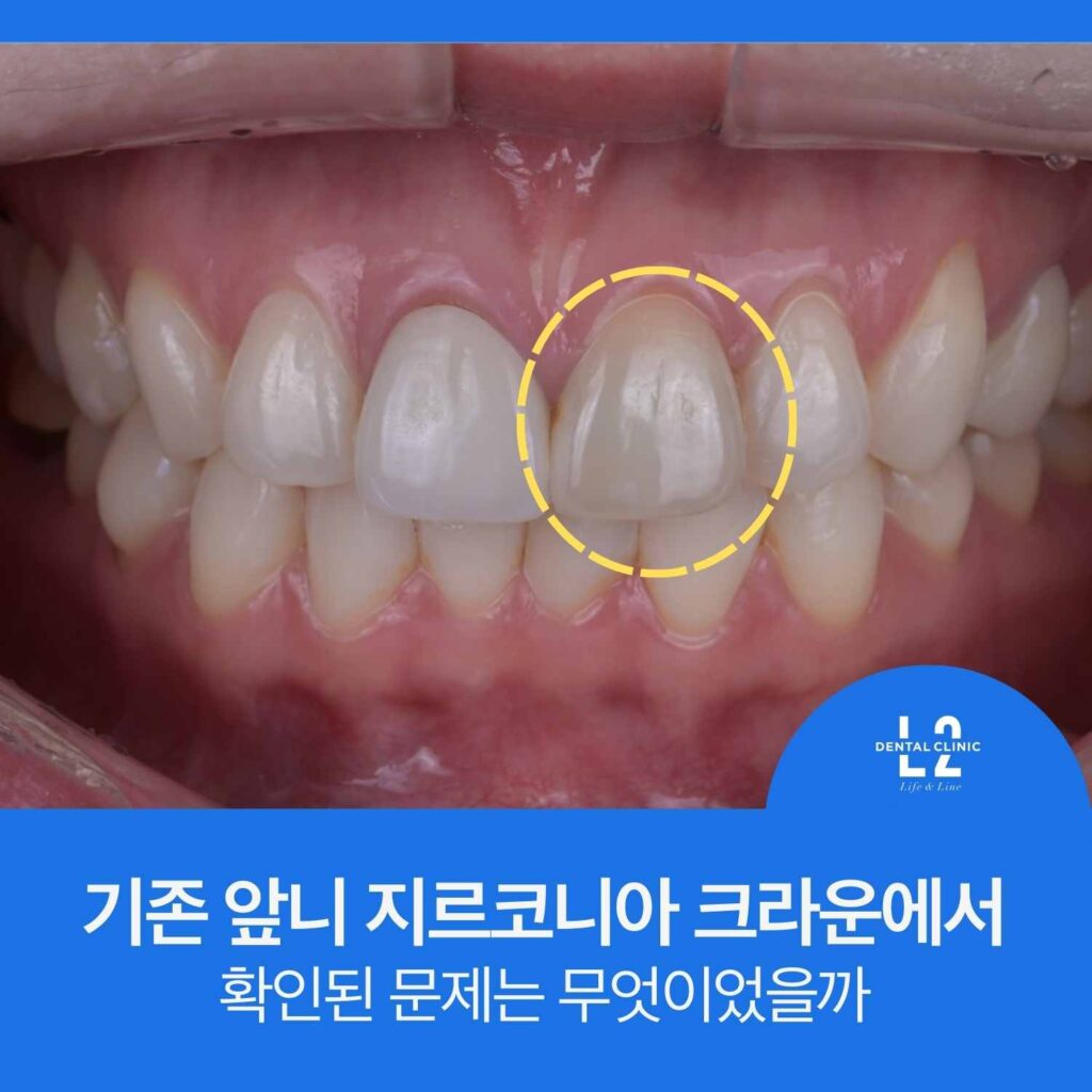 기존 앞니 지르코니아 크라운에서 색상과 조화 문제를 표시한 구강 사진