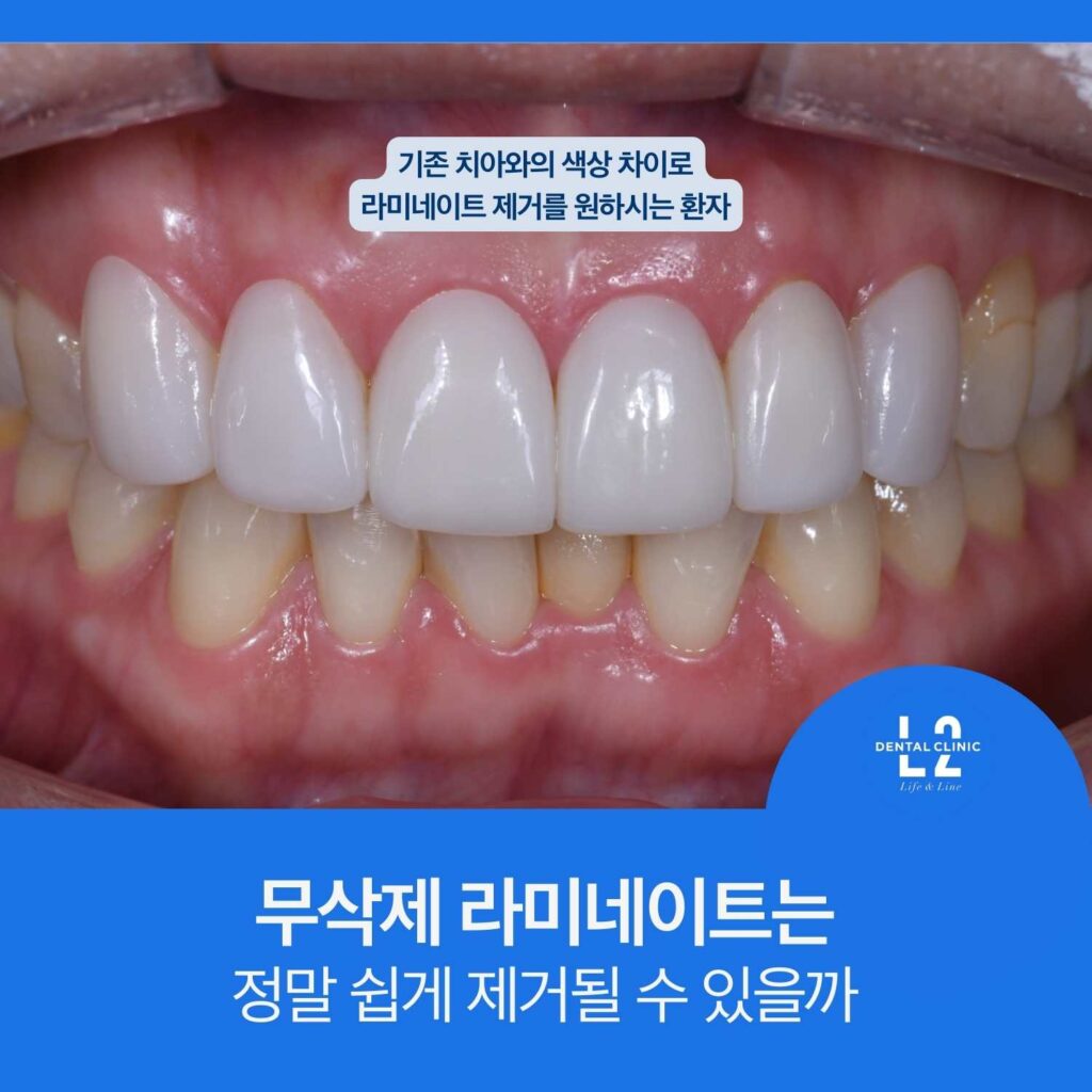 기존 치아와 색상 차이로 무삭제 라미네이트 제거를 고민하는 앞니 상태