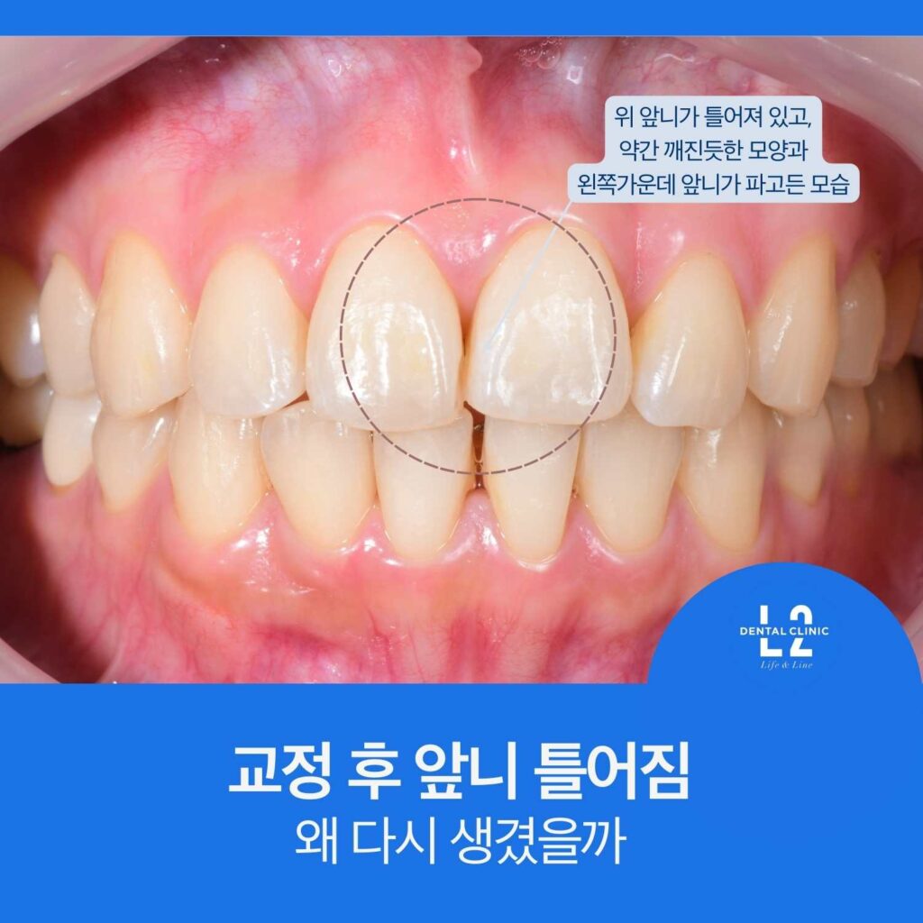 교정 치료 후 유지장치 탈락으로 앞니 배열이 다시 틀어진 구강 내 사진