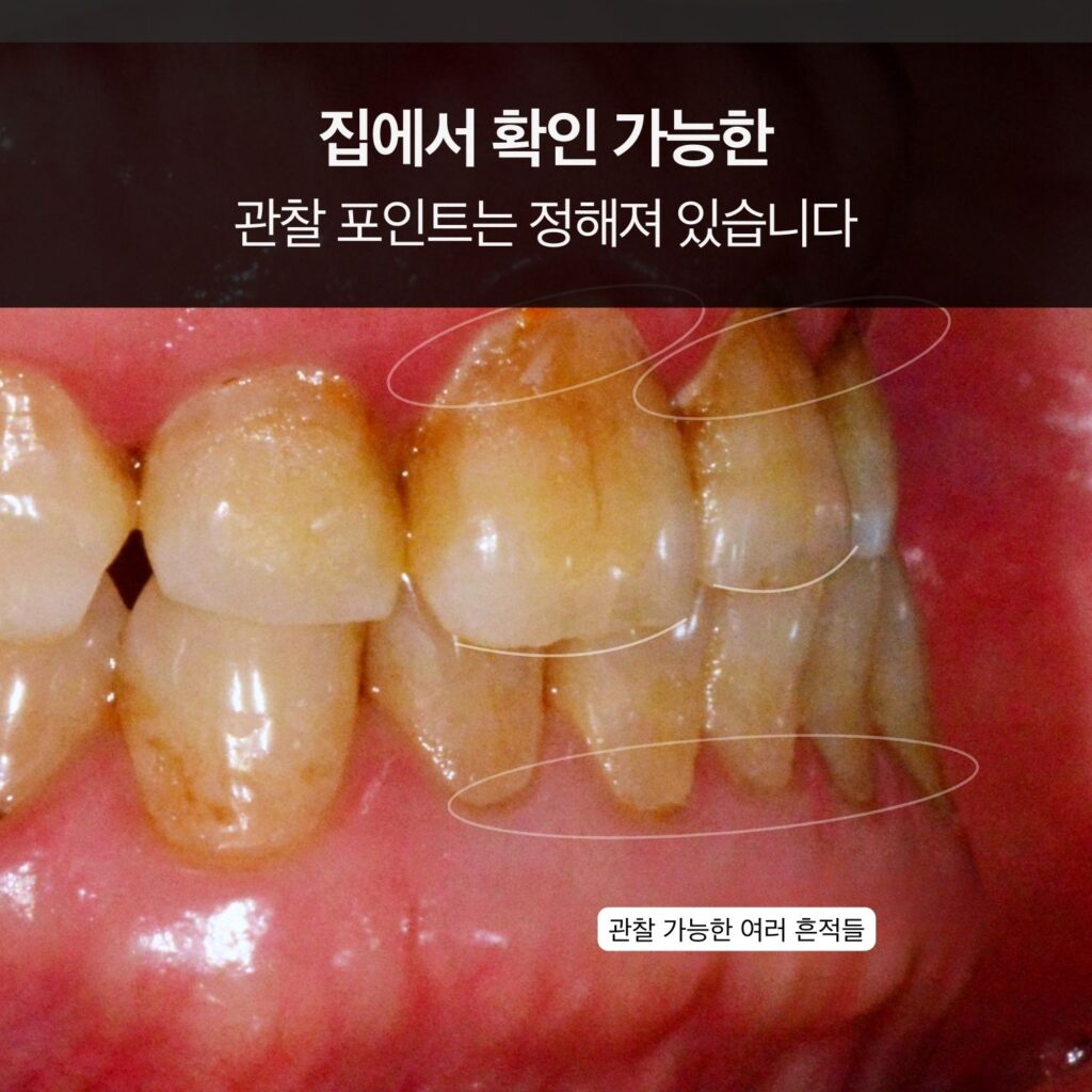 치아 클로즈업 사진에 동그라미 표시로 흔적을 강조하고 ‘집에서 확인 가능한 관찰 포인트는 정해져 있습니다’ 문구가 있는 이미지