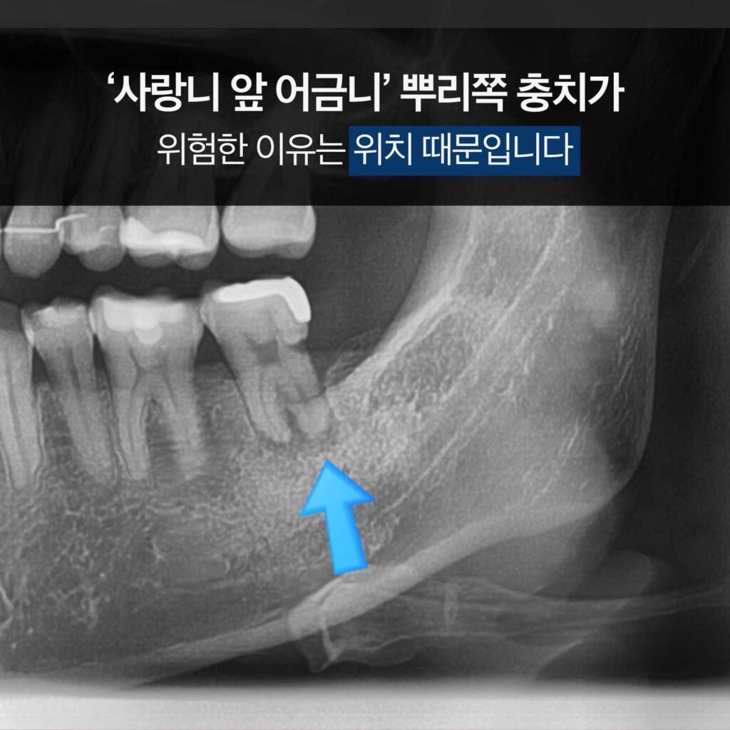 아래턱 어금니 엑스레이에서 화살표로 부위를 가리키며 ‘사랑니 앞 어금니 뿌리쪽 충치가 위험한 이유는 위치 때문’ 문구가 있는 이미지