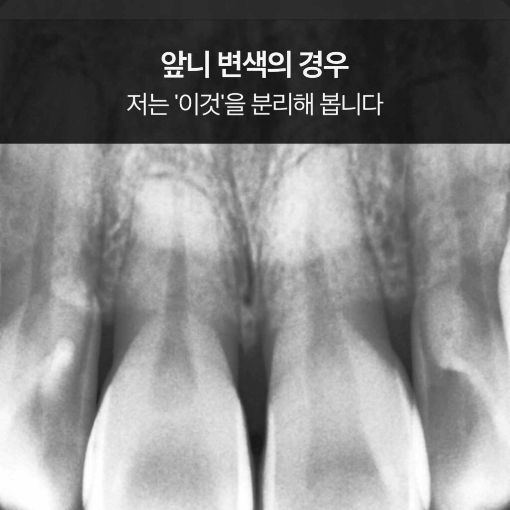 앞니 부위 치근단 엑스레이(흑백) 이미지 위에 “앞니 변색의 경우 저는 ‘이것’을 분리해 봅니다”라는 문구가 상단에 배치된 카드.