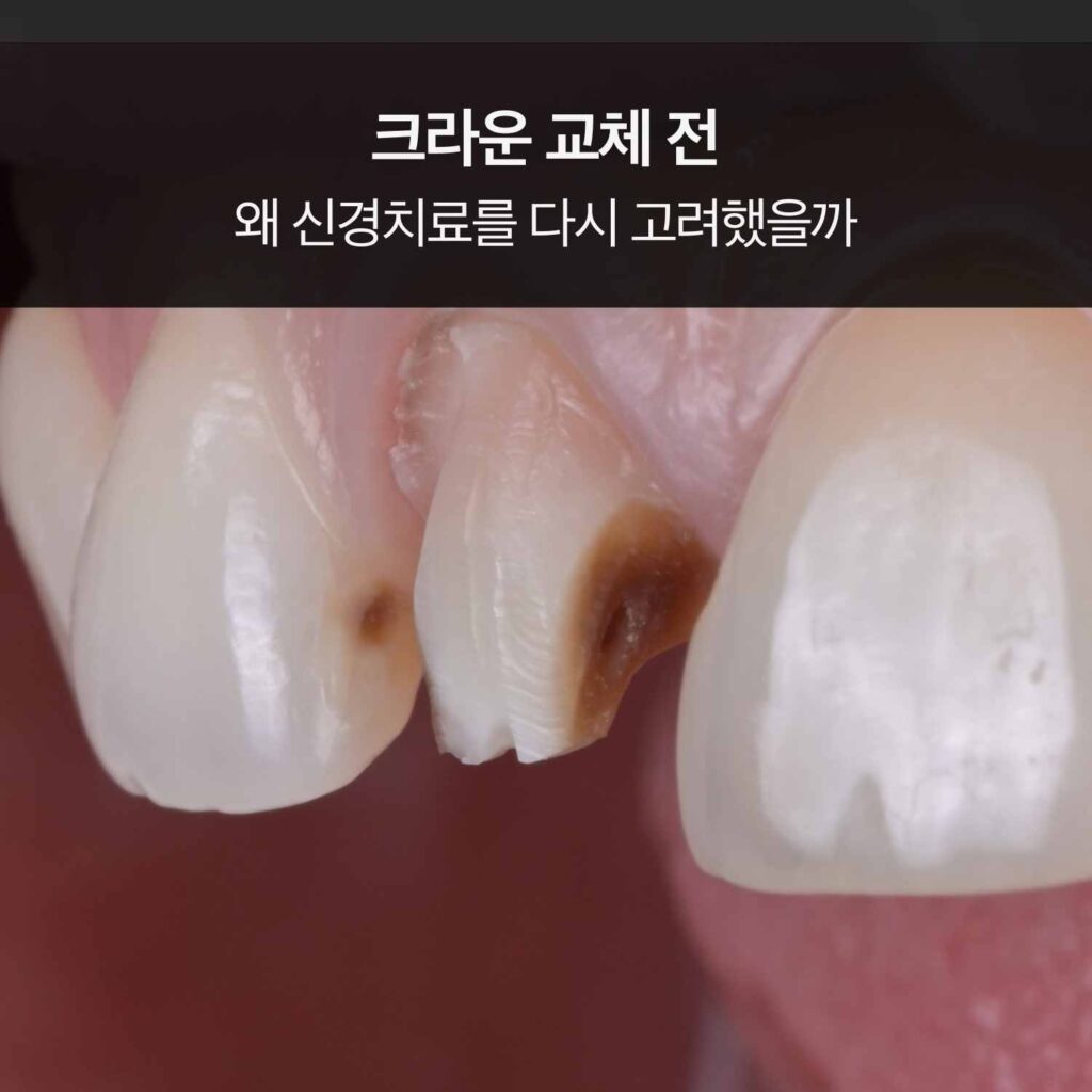 앞니 크라운 제거 후 내부 변색과 충치가 확인된 치아 모습