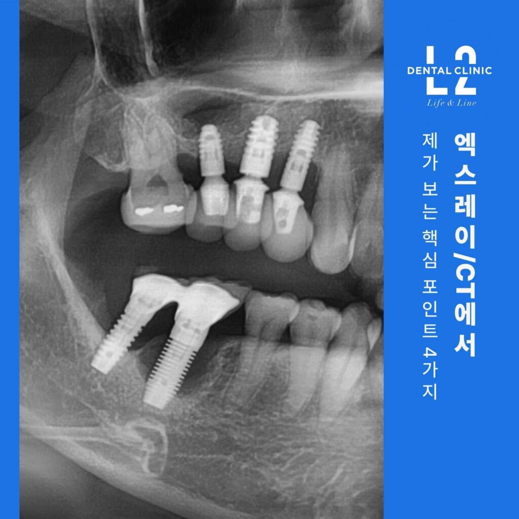 파노라마 엑스레이에서 임플란트와 주변 잇몸뼈 상태를 확인하는 이미지