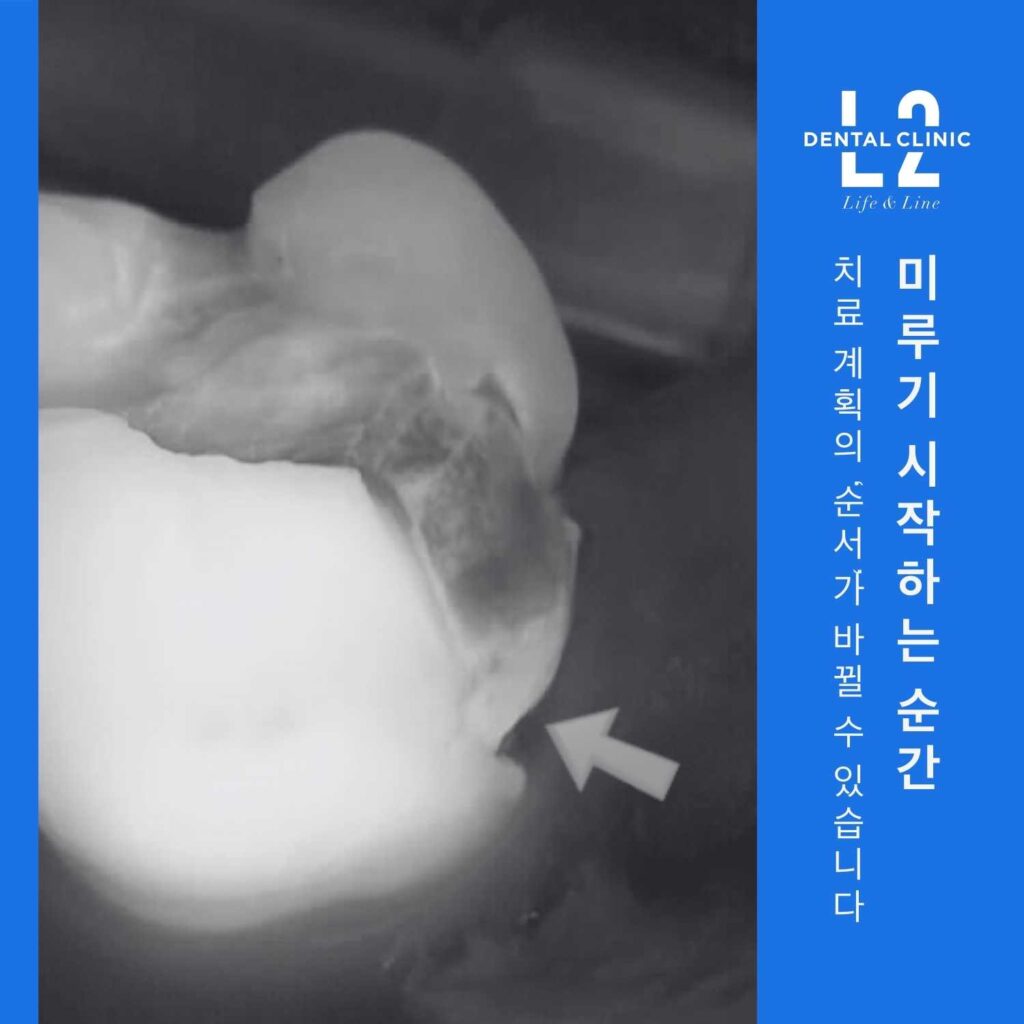 치아 엑스레이 이미지에 화살표 표시와 함께 ‘미루기 시작하는 순간 치료계획의 순서가 바뀔 수 있습니다’ 문구가 있는 카드