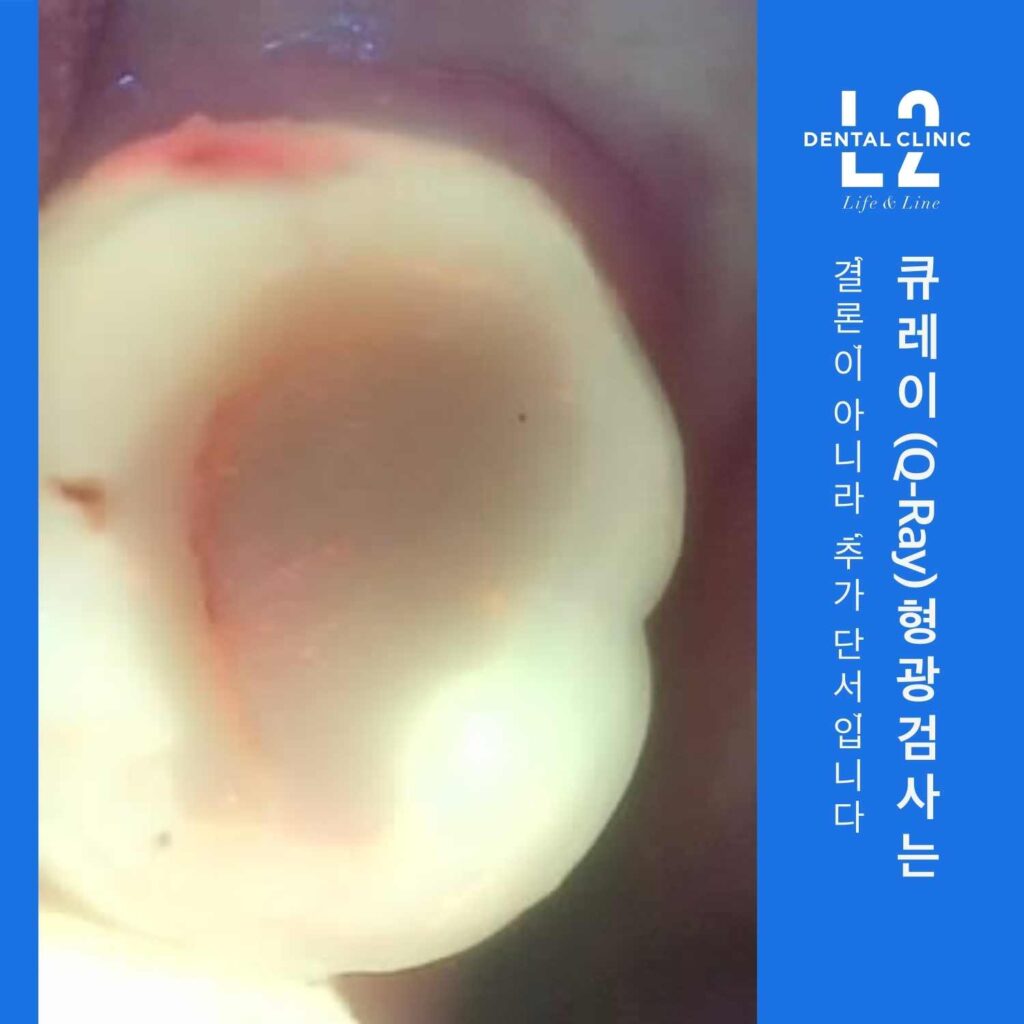치아 클로즈업 사진과 우측 파란 띠에 “큐레이(Q-Ray) 평0? 검사는 결론이 아니라 ‘추가 단서’입니다” 문구가 있는 카드