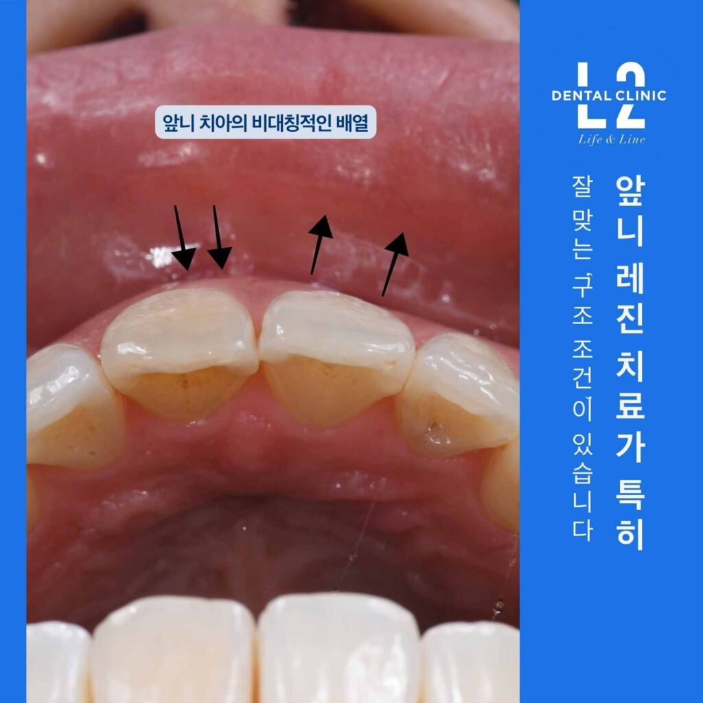 윗앞니를 아래에서 올려다본 구강 사진에 화살표가 표시되어 있고 “앞니 치아의 비대칭적인 배열” 문구가 있다. 오른쪽에는 파란 세로 배너로 “앞니 레진 치료가 특히 잘 맞는 구조 조건이 있습니다”라는 문구와 로고가 있다.