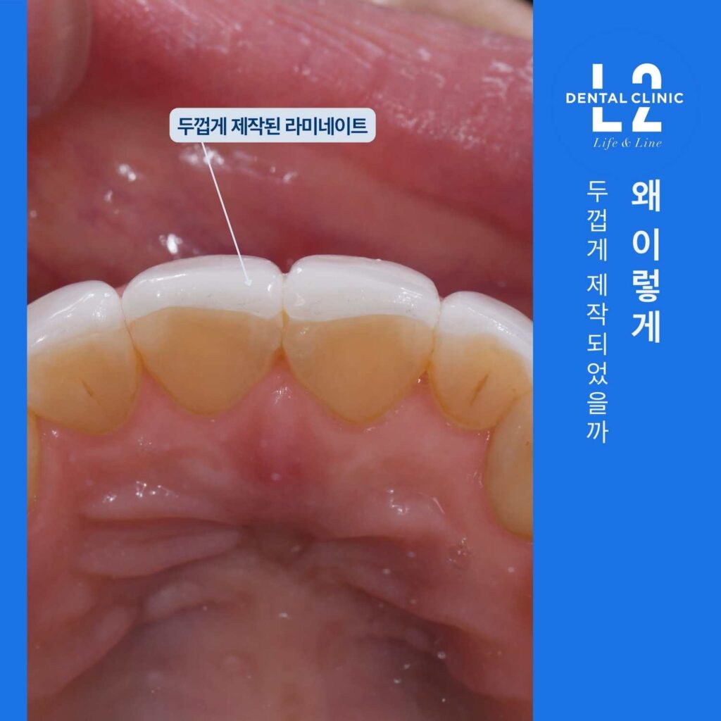두껍게 제작된 무삭제 라미네이트로 인해 치아가 커 보이는 모습