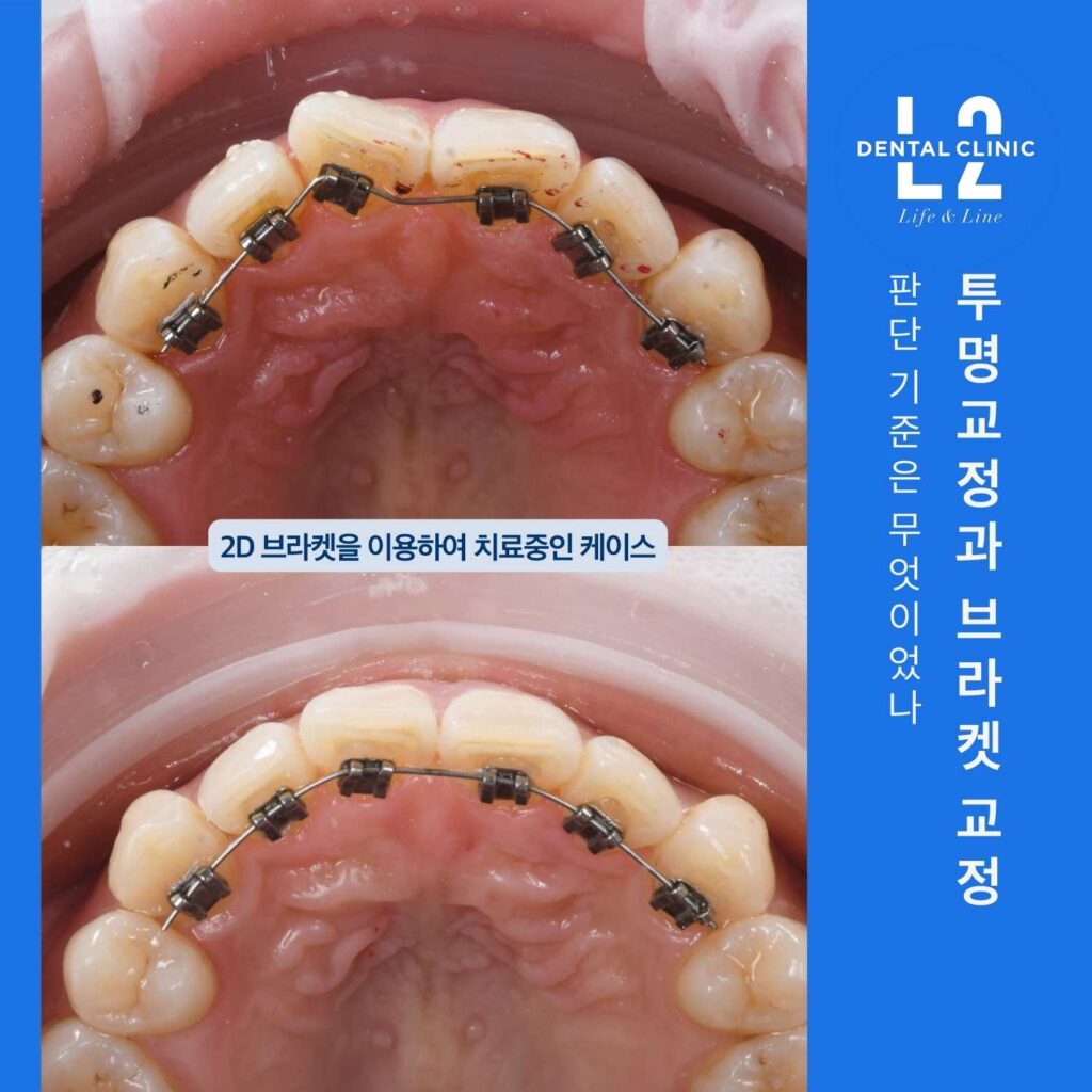 앞니 안쪽에 2D 브라켓을 부착해 부분교정을 진행 중인 구강 내 사진