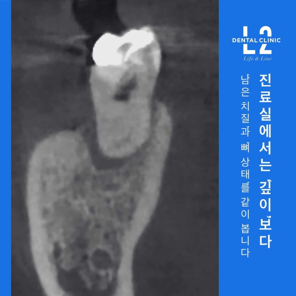 CT처럼 보이는 단면 영상에서 치아와 뼈 상태를 보여주며 ‘진료실에서는 남은 치질과 뼈 상태를 같이 봅니다’ 문구가 있는 카드