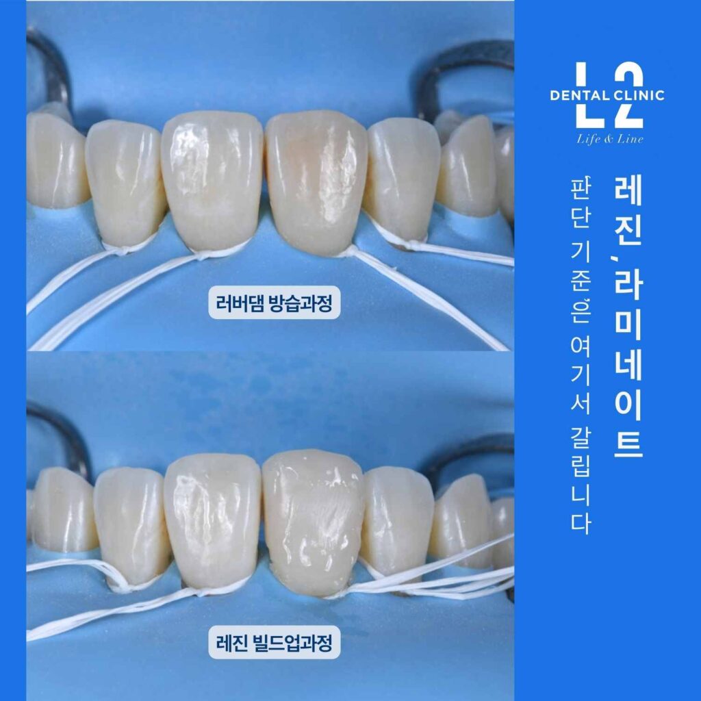 러버댐이 적용된 앞니 사진이 위아래 두 장으로 구성되어 있고, 각각 “러버댐 방습과정”, “레진 빌드업과정” 라벨이 붙어 있다. 오른쪽 파란 세로 배너에 “레진·라미네이트 판단기준은 여기서 갈립니다” 문구와 로고가 있다.