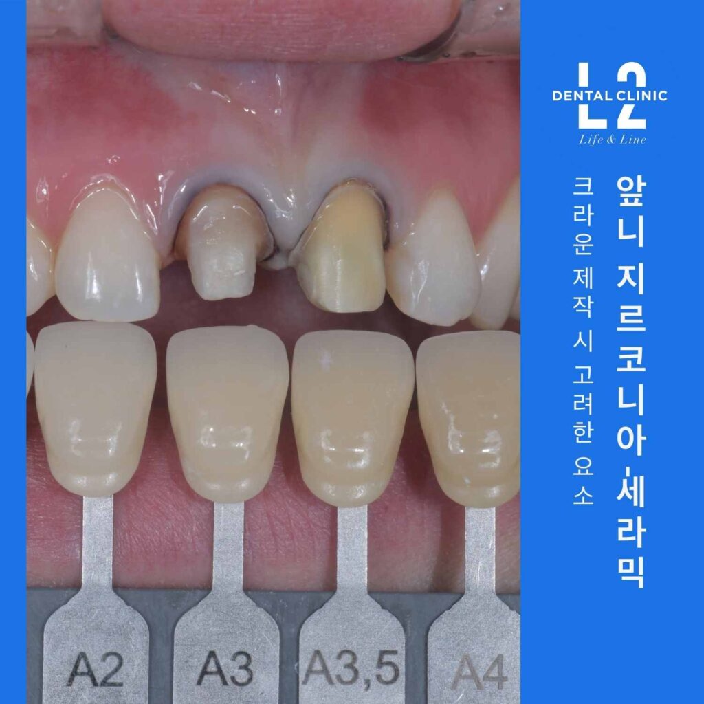 앞니 지르코니아 크라운 제작을 위한 쉐이드 가이드 색상 비교 사진