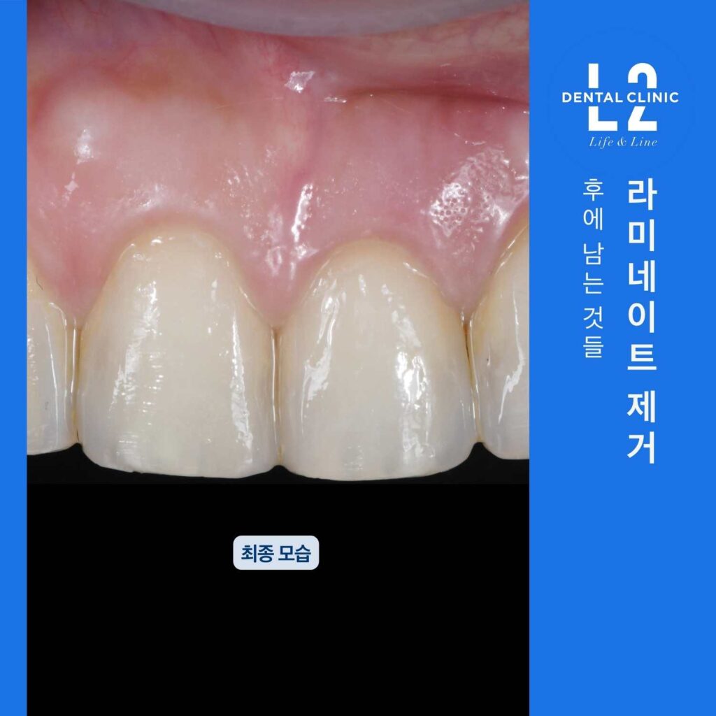 라미네이트 제거 후 치아 표면이 이전과 달라진 모습