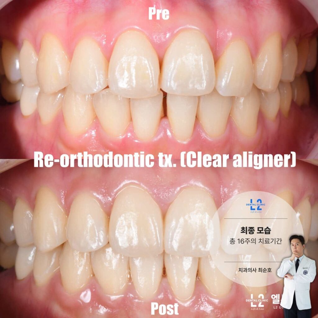 투명교정 장치를 이용한 앞니 재교정 전후 비교 사진