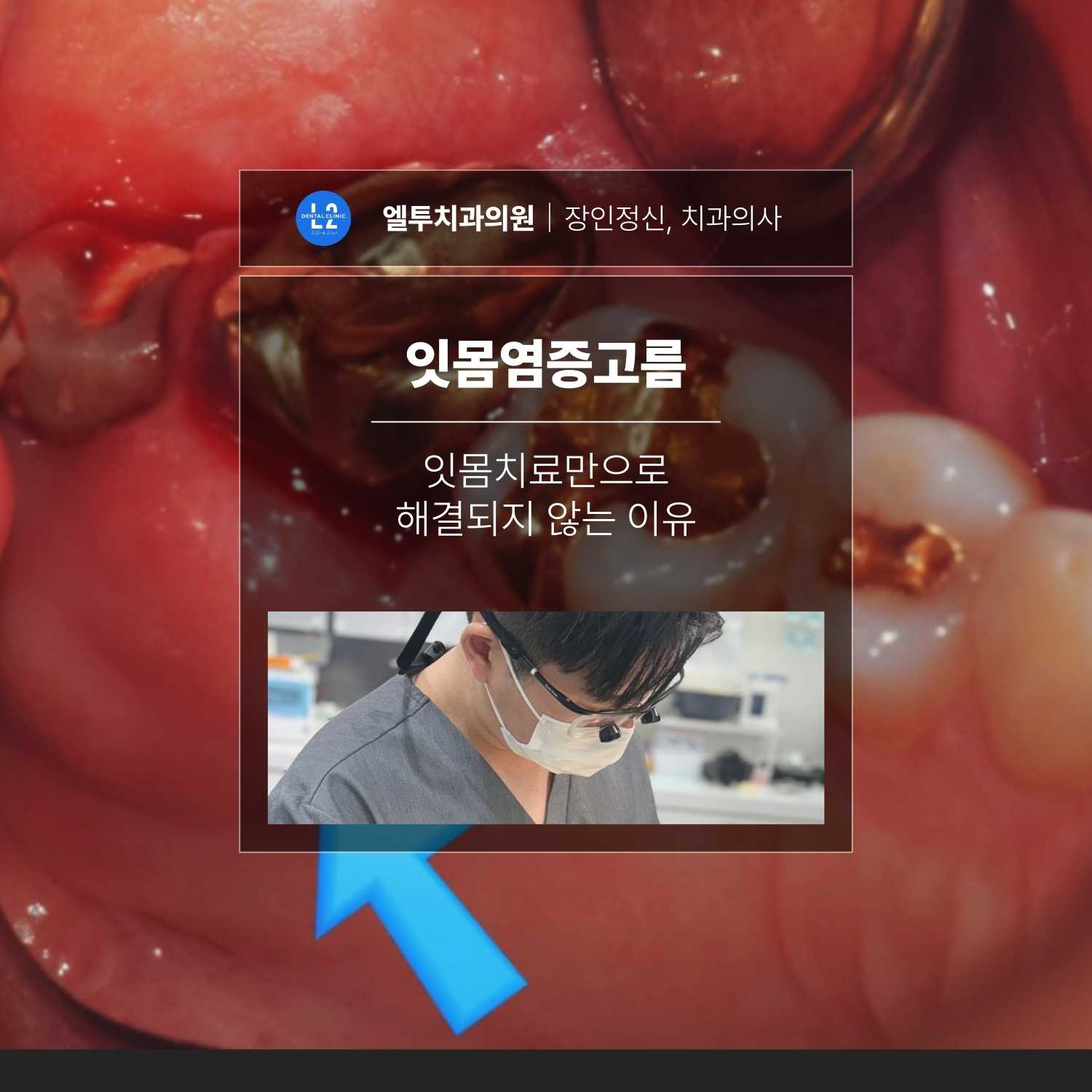 잇몸염증고름이 발생한 어금니 부위와 염증 소견을 설명하는 이미지