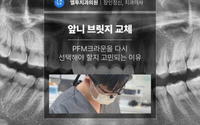 앞니 브릿지 교체 시 PFM크라운을 다시 선택해야 할지 고민되는 이유