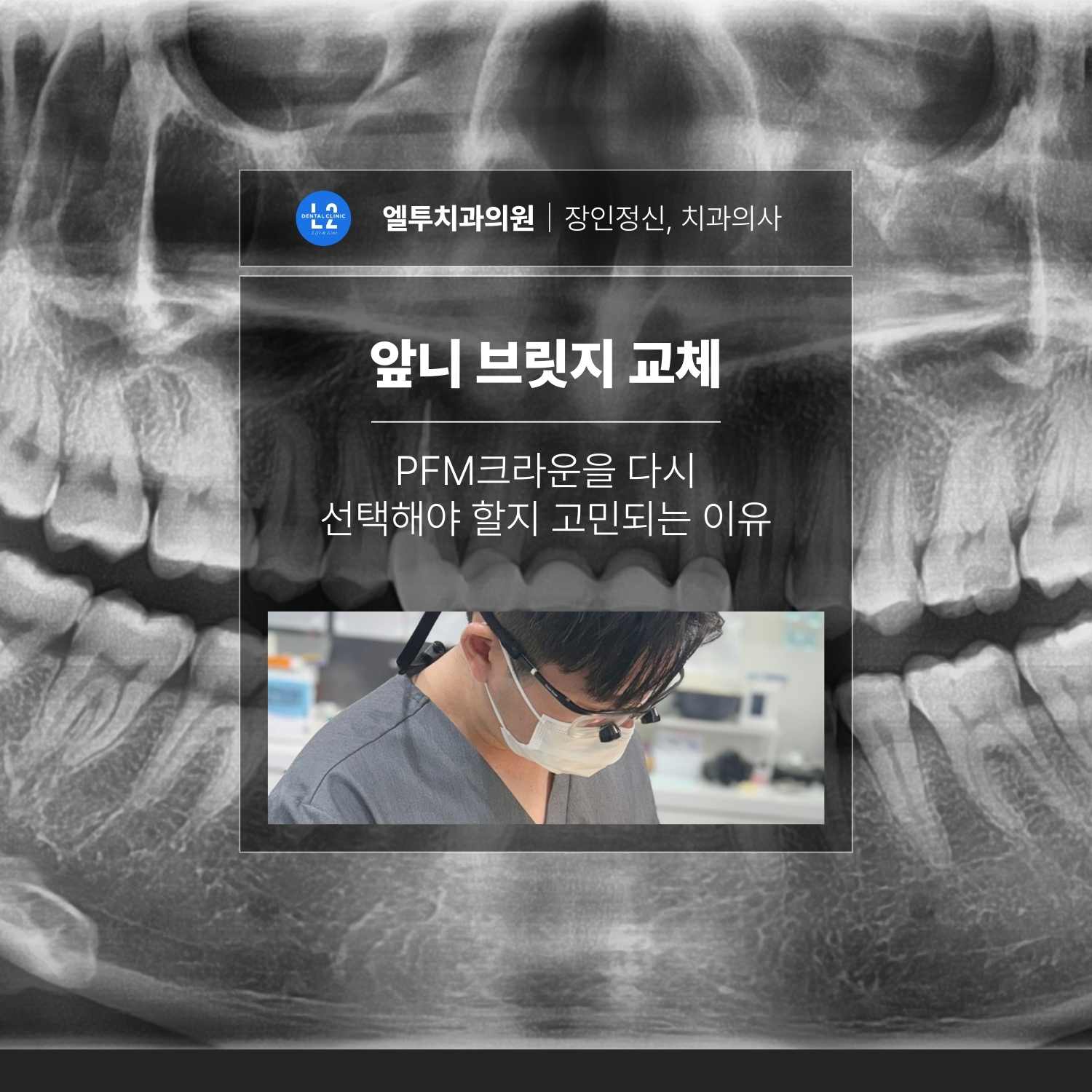 앞니 브릿지 교체와 PFM크라운 선택을 설명하는 엘투치과 콘텐츠 대표 이미지